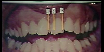 Cartel de Burn Bundy Burn